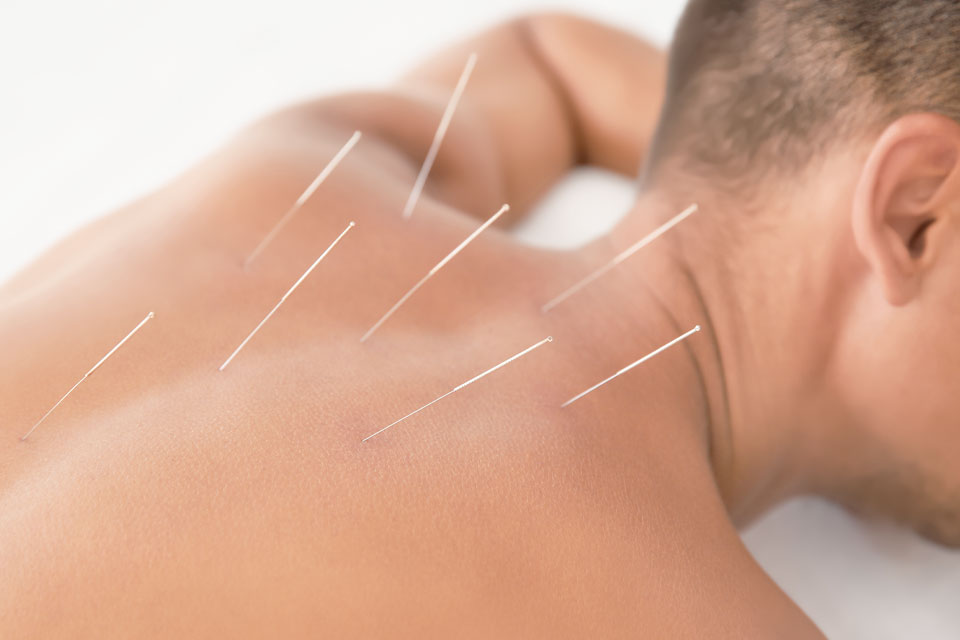 A man with acupuncture needles in his back.